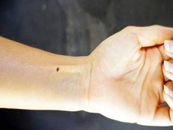 Giải mã ý nghĩa nốt ruồi son ở cánh tay